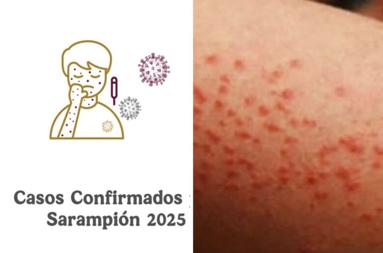 sarampion